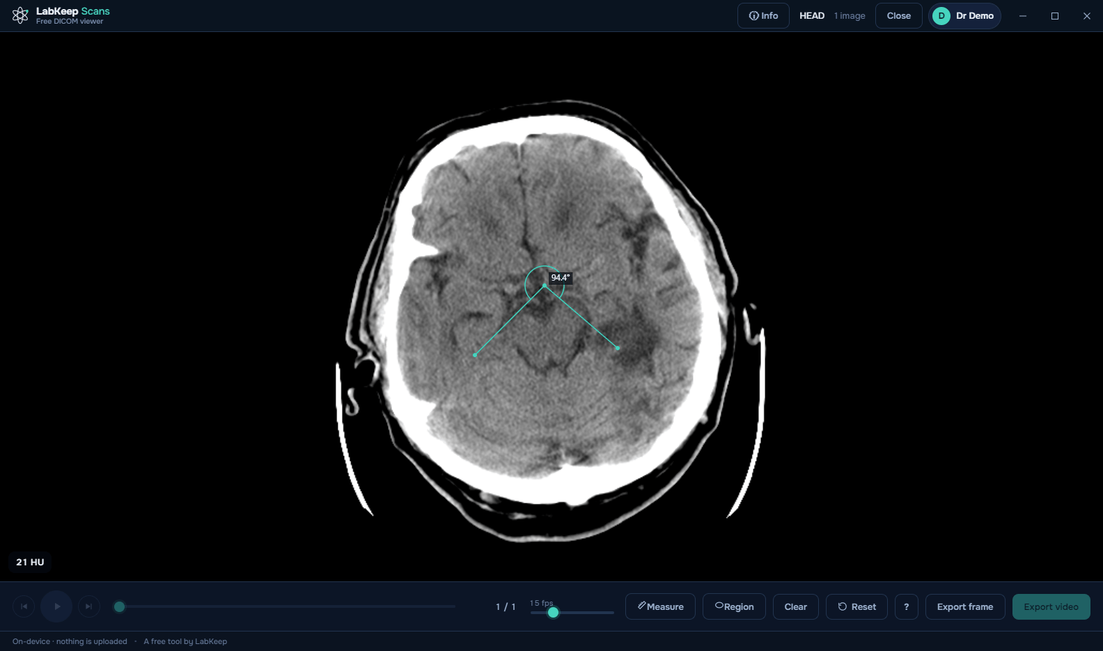 LabKeep Scans showing a 94.4 degree angle measurement on a head CT