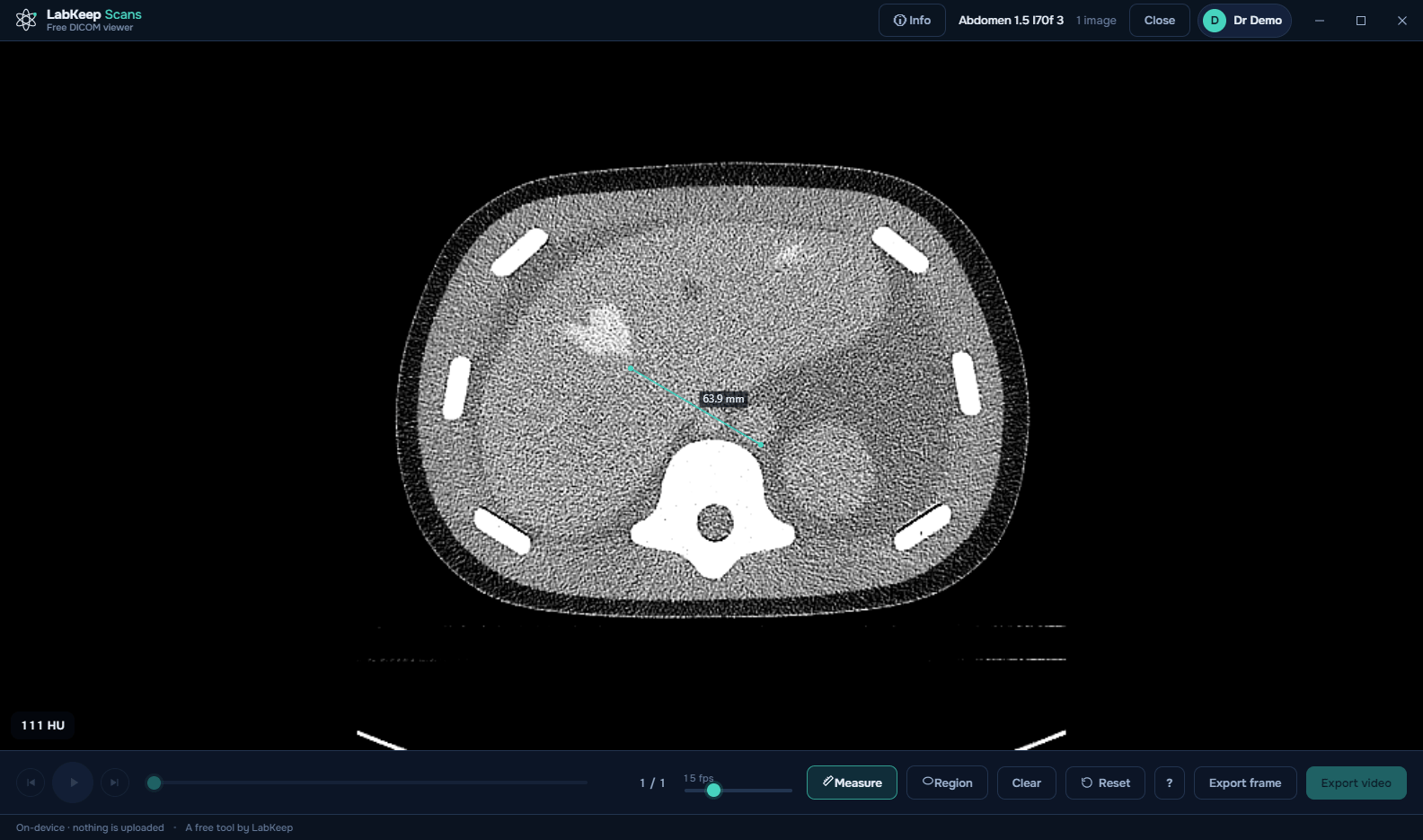 LabKeep Scans showing a 63.9 mm distance measurement and a live 111 HU readout on an abdominal CT