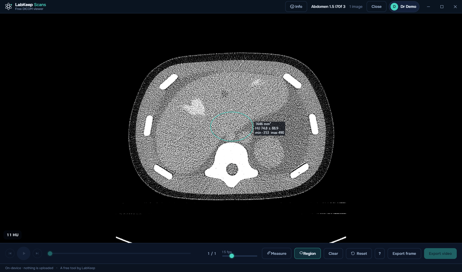 LabKeep Scans showing an elliptical ROI with 1646 mm², HU 74.8 ± 88.9, min -353, max 490